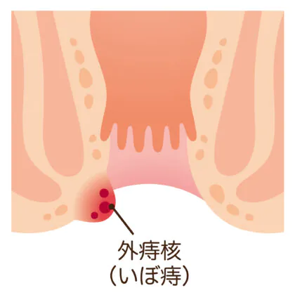 いぼ痔
