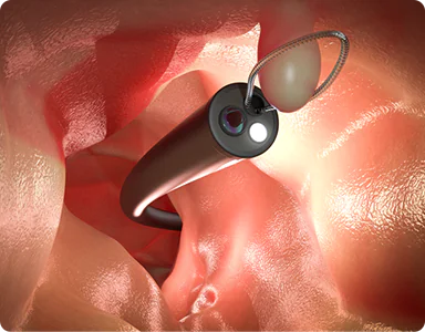 大腸ポリープの日帰り切除手術対応