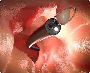 大腸ポリープの日帰り切除手術対応